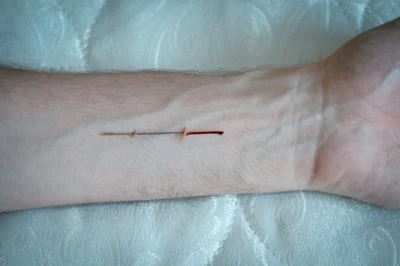 Cuchillas de afeitar para laparoscopia: escenarios de aplicación clínica